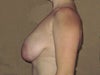 I can remember what my breasts looked like when they first started developing around the age of 10, and they were exactly like the tiny tuberous breasts that I have seen on the internet, but in my case they just kept growing! Perhaps extended use of birth control starting at age 12 had something to do with that?