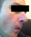 Nose 7 weeks post-op