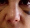 This is one week post surgery and my nose is a blob. Will is go back to normal - better than normal?