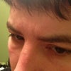 2 small indented scar like creases