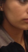Close up of right cheek.
