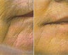 Laser Treatment Before and After Photos