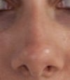 My original nose (I just had a bump on the bridge and that's all I asked to be removed)