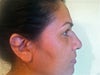 1st rhinoplasty by the Chief plastic surgeon in Miami. Dr. S. Anthony Wolfe. ( he butchered my nose)