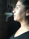 Revision rhinoplasty at 5 weeks
