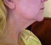 pre surgery 9/4/12