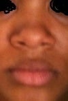 Nose Advice