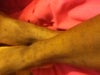 The scars are just many black spots. Sorry if I failed to portray that in the pictures.