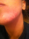 current cysts on jaw. keep picking, but have lost track of diet as well.