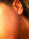 pitted scars on left cheek