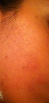 pitted scars on right cheek