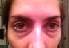 Tired Eyes.