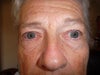 Bags and eyelid droop.
