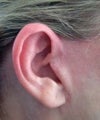 Right Ear