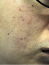 right cheek