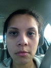 Hyperpigmentation and ptosis. What can I do? To lighten it? Thanks