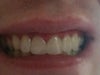 Veneers