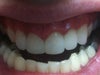 Bottom teeth vs top.