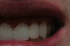 End of veneers