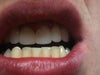 Bottom teeth comparison