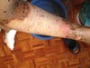 Right arm
2nd and 3rd degree?