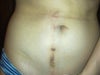 This picture taken 4 years after my scar revision.