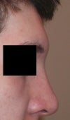 After pressing. I'm happy with how it looks here, and I really hope that this is something similar to how the final results will look. It just feels like the swelling will never go down on its own