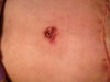 BB 8 weeks post op. Redness on L chronic. PS says "its fine"