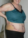 here is am 9 days after my surgery