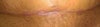 Why is it starting to dip in like that?? Do i need to get another stitch removed?!