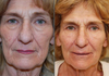 Non surgical Face lift before & after photos