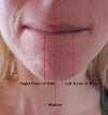 Jawline asymmetry. Not the easiest to see because my skin is soft around the chin, but an ortho pointed this out to me. My right jaw seems to be longer than my left which pushes my chin off center and makes my right chin point lower than my left. I can also feel along my jawline and see that the ortho's observation was correct.