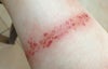 immediately after 1st laser