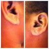 Left and Right ears where previous keloids were removed