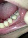 Photo showing filling that extends below the gumline