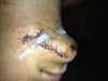 Stitches
