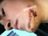 When I got my stitches off.