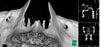 infraorbital canals