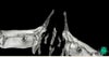 infraorbital canals inside of the skull