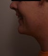 after - smiling