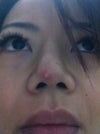 bump at the tip of the nose