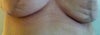bruising? below bra line on left chest.