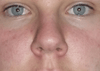 Here you can kind of see the valve collapse, at least that's what I think it is. It's hard to breathe out of the lower sagging nostril and sometimes when I push it up, I hear the cartilage "click" into place.