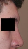 And after pressing. It only stays like this for a few minutes :\ I'd be really happy to know that my end results will look like this. The bump on my nose before pressing can't be bone, right? It goes down when I press... and It's very spongy feeling. Is it possible that the bump is permanent even if it goes down with pressure?
