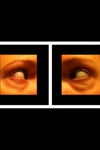 PRE-SURGERY pic on R shows my eye that received trauma, pic on L shows my normal eye