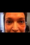 smiling - 2 weeks post op