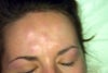 Developed incredibly sore tender swollen lumps at each injection point. Unbearable to touch.