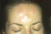 12hrs after taking prednisolone 25mg, no improvement.