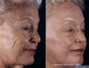 Laser Peel Before and After Photos