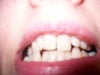 teeth straightening with metal braces or Invisalign
